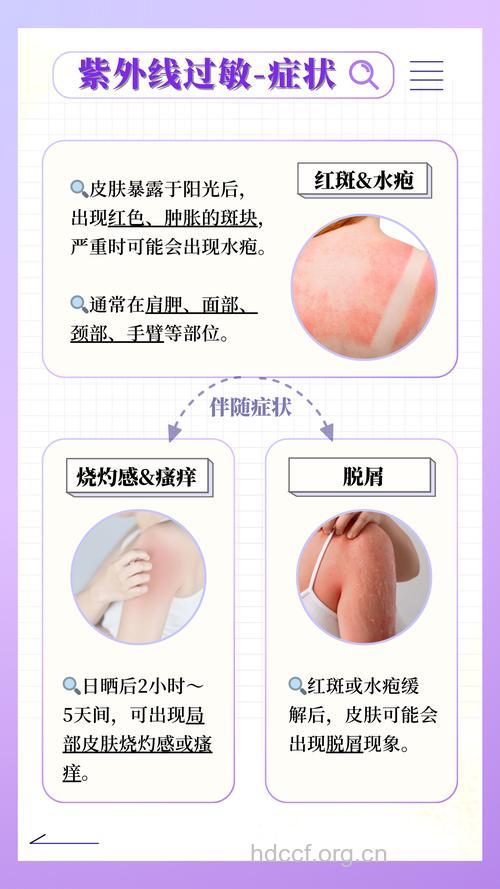 紫外线过敏怎么办 3大病因要了解