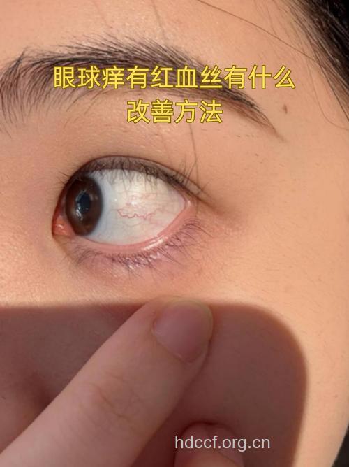 戴隐形眼镜为什么会过敏