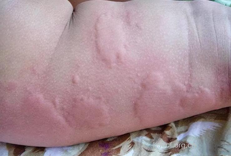 儿童荨麻疹有什么特殊性