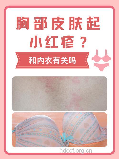 炎热夏季 当心隐形文胸致皮肤过敏