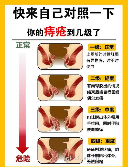 为何患上痔疮的人越来越多了