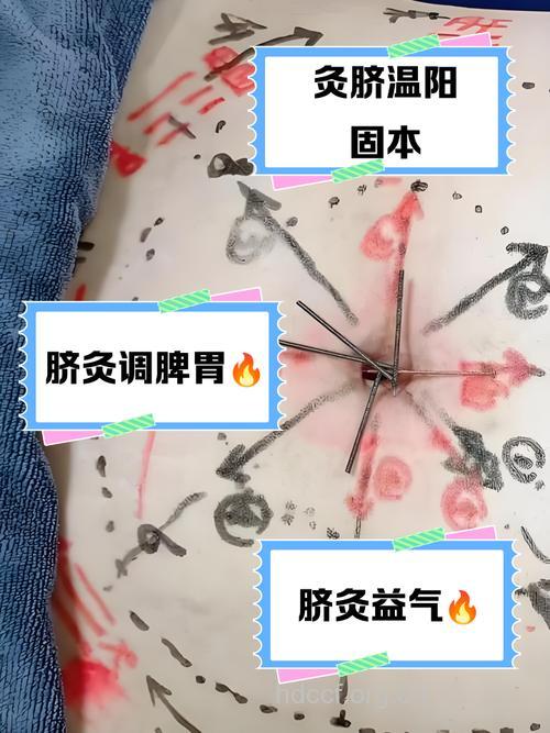 中医怎么用脐疗治疗荨麻疹