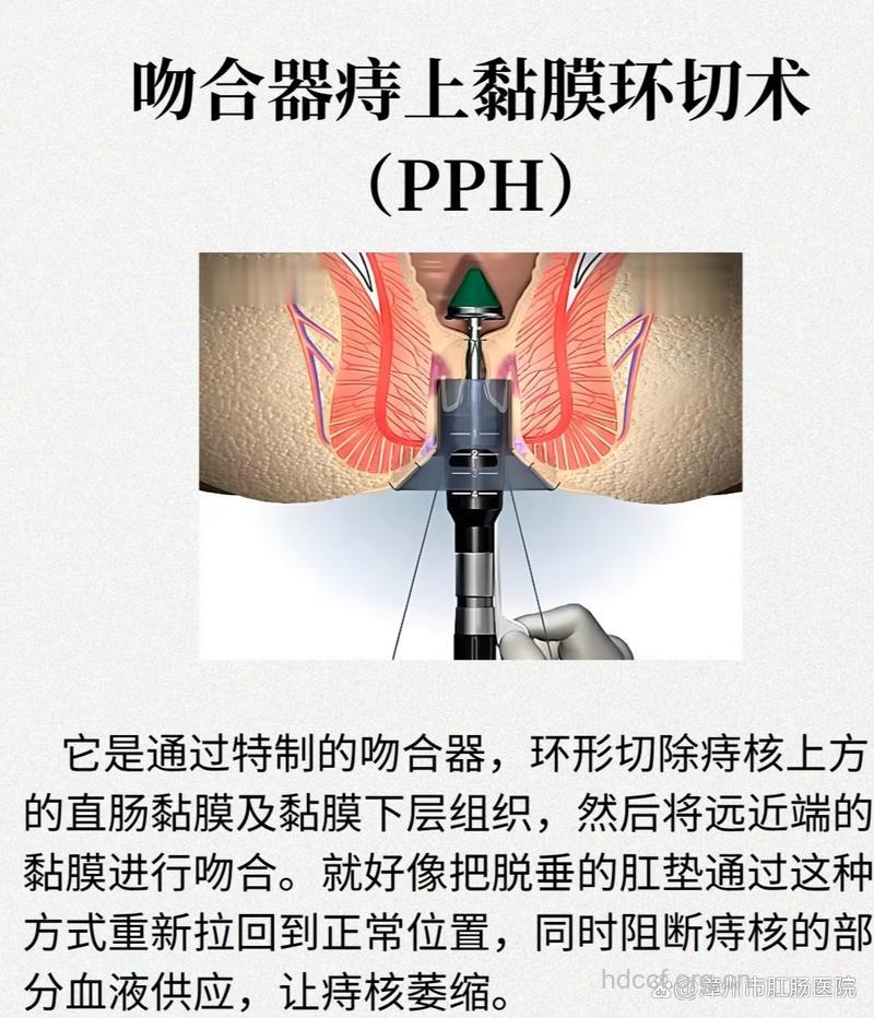 tst环切术科学治疗痔疮