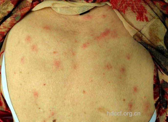 睡草席引发“草席皮炎”