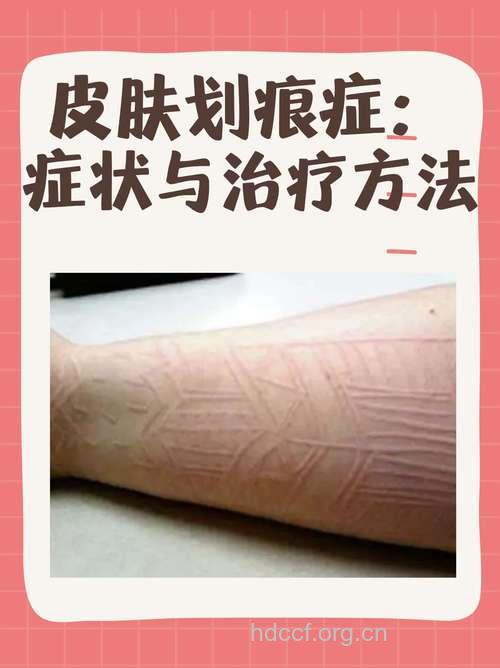 如何防治皮肤划痕症