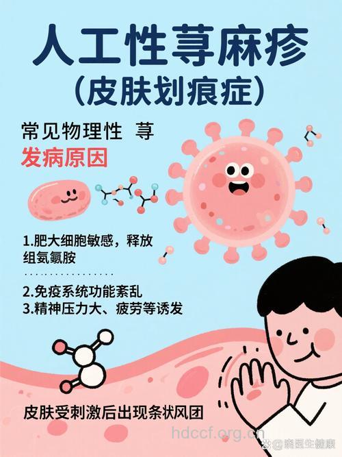 为什么会导致人工荨麻疹