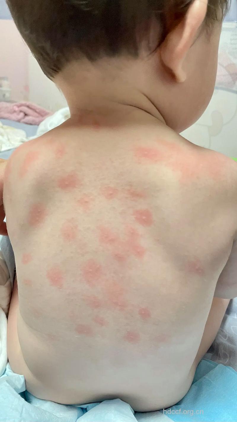 儿童荨麻疹有哪些临床表现