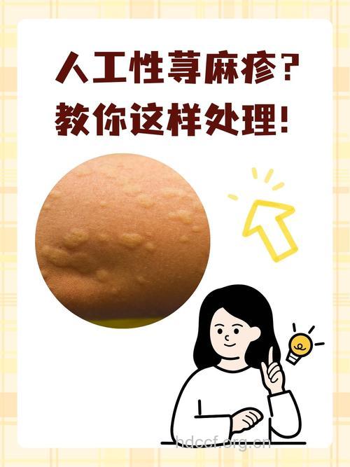 人工荨麻疹怎么办