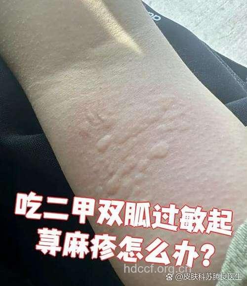 降糖药也会引发皮肤过敏吗