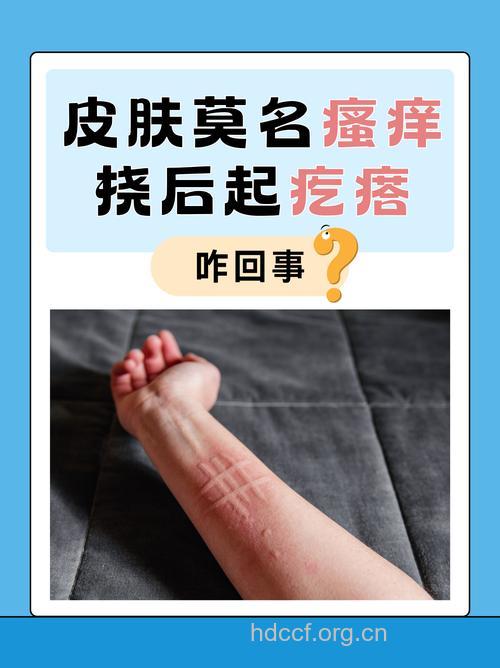 潘生丁治疗荨麻疹