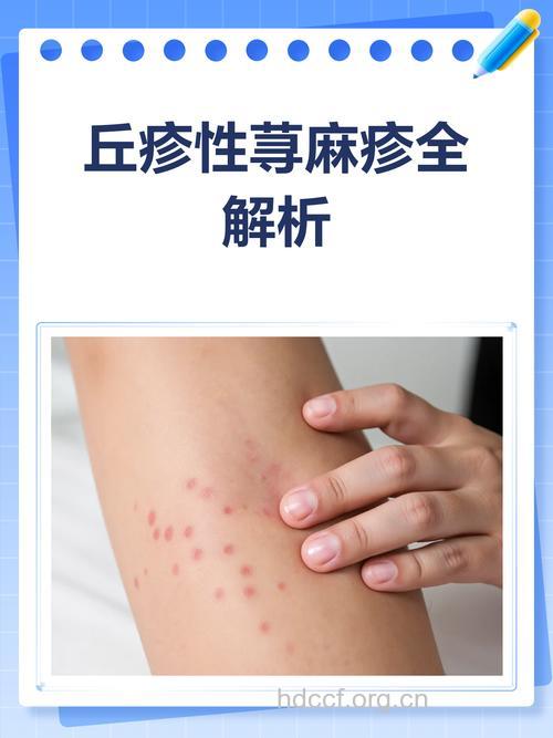 你患有丘疹样荨麻疹吗