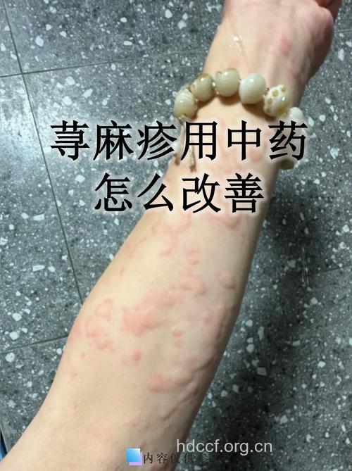 中药治疗荨麻疹近况