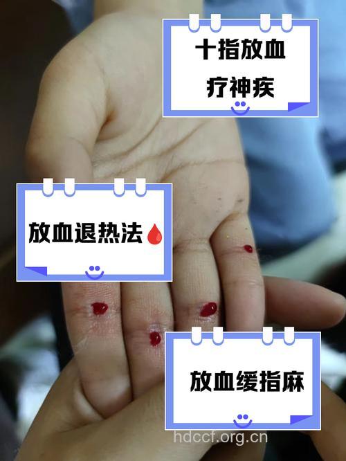 放血疗法治荨麻疹