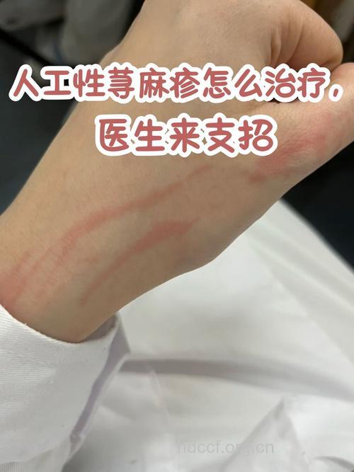 难缠的人工荨麻疹如何治疗？