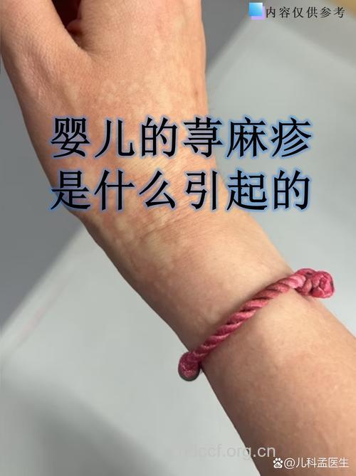 小儿腹痛,可能是荨麻疹