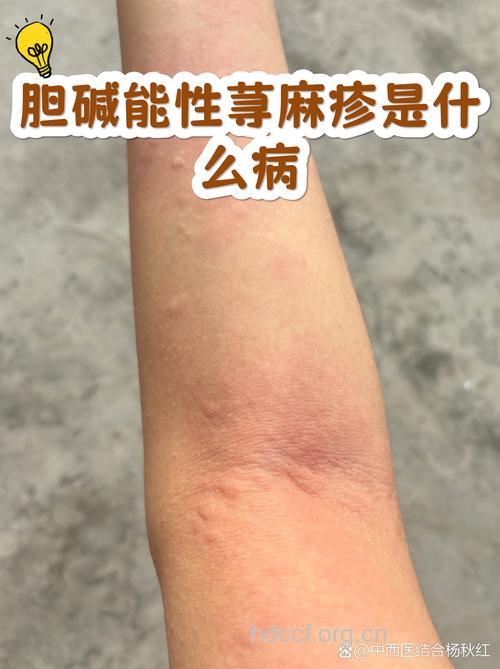 走近胆碱能性荨麻疹