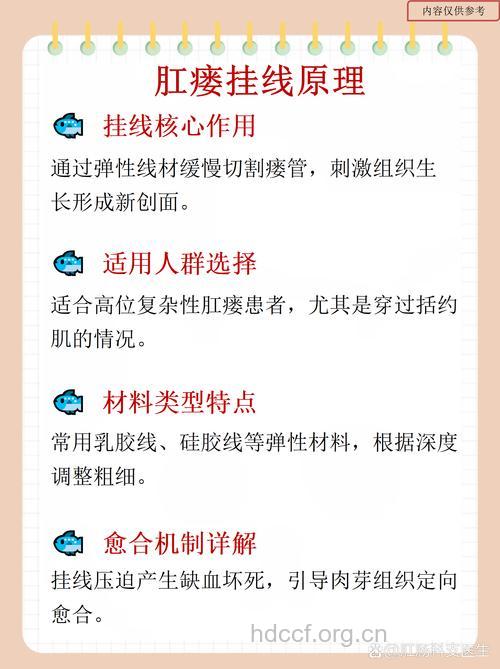 肛瘘的挂线疗法