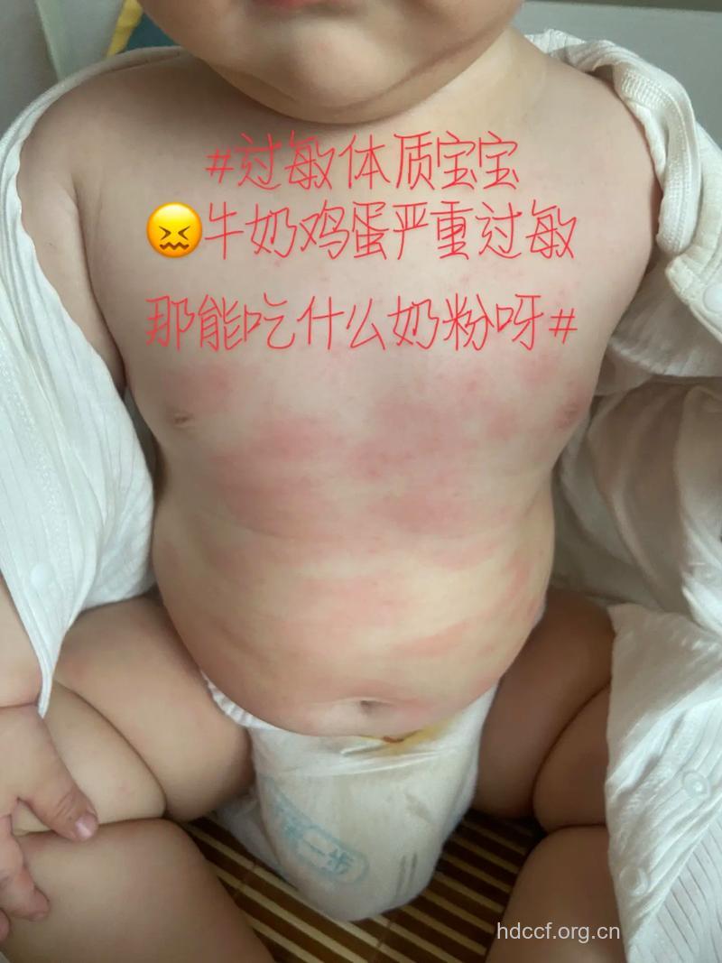 孩子皮肤过敏不宜吃鸡蛋
