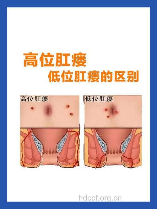怎么确定肛瘘患者的内口位置