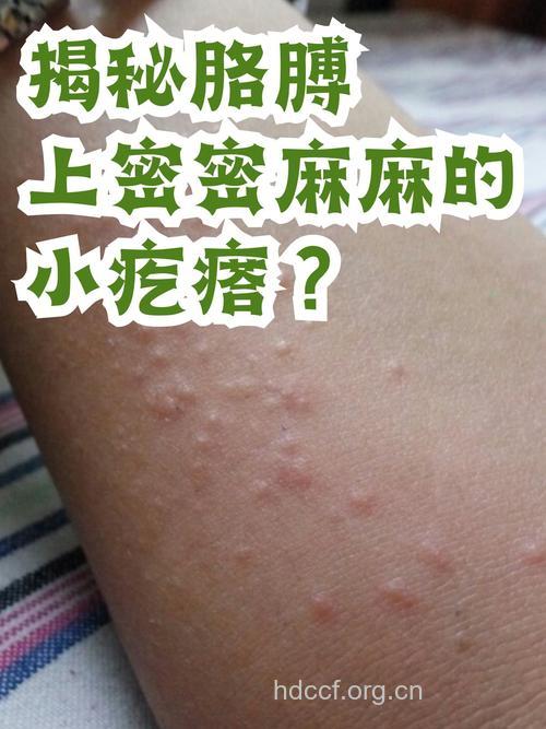 皮肤上的小疙瘩不可忽视!