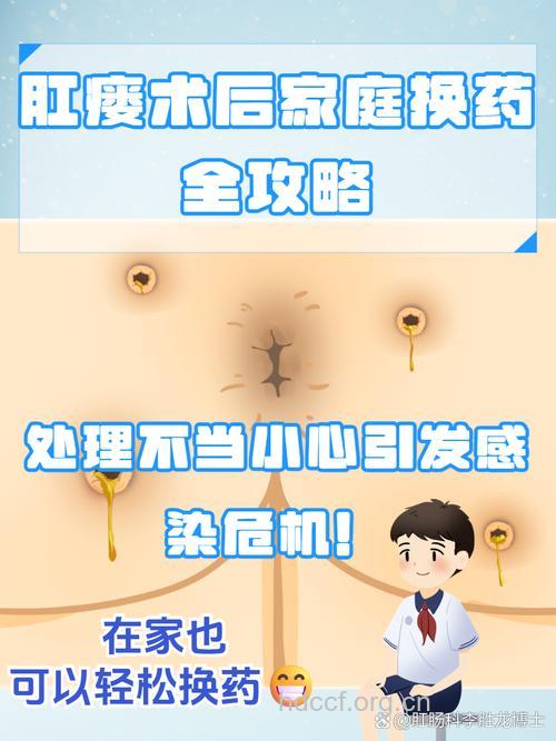 肛瘘术后怎么换药