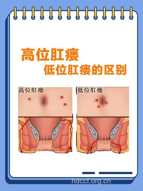 怎么分辨肛瘘和直肠癌