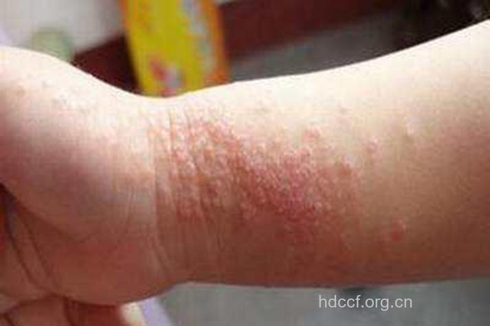 儿童接触性皮炎大盘点