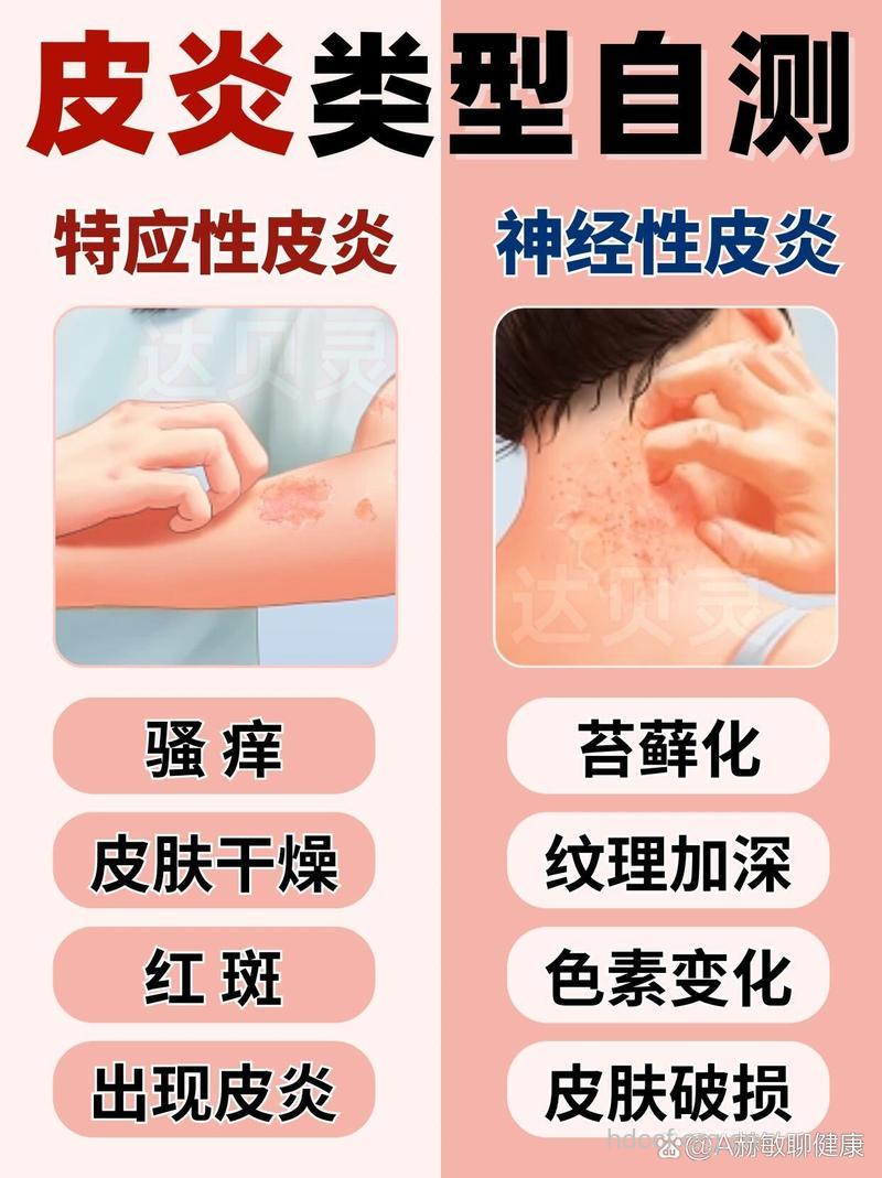 专家教你自测接触性皮炎