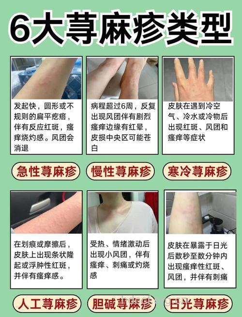 荨麻疹的病程分类