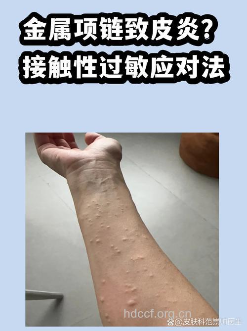戴项链谨防接触性皮炎 接触性皮炎治疗