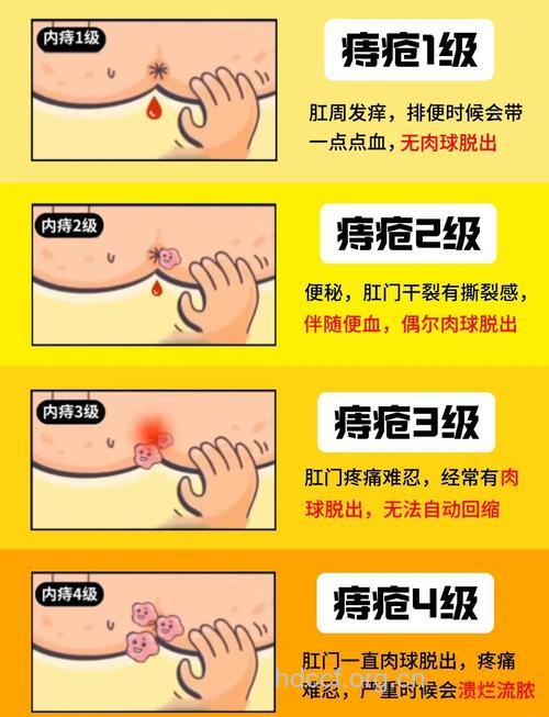 哪些方法预防混合痔