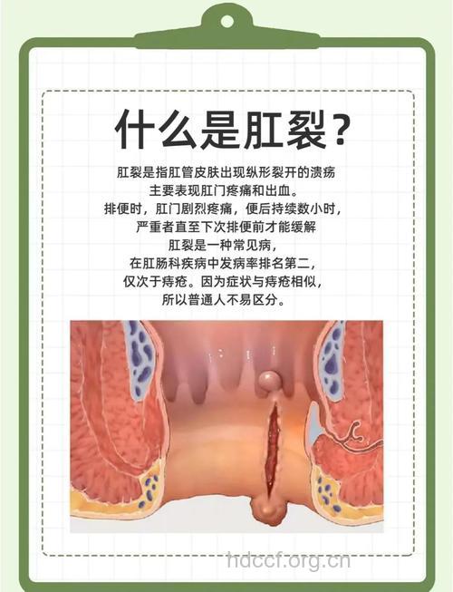 反复肛裂该怎么办