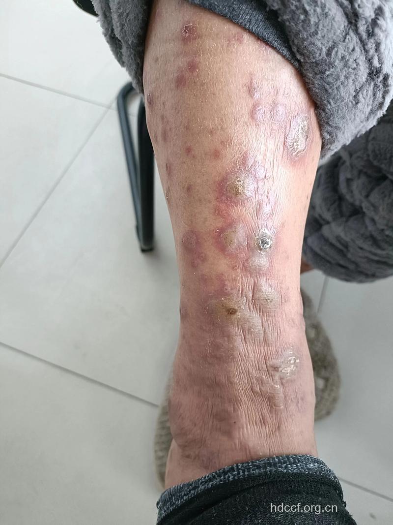 中药治疗接触性皮炎