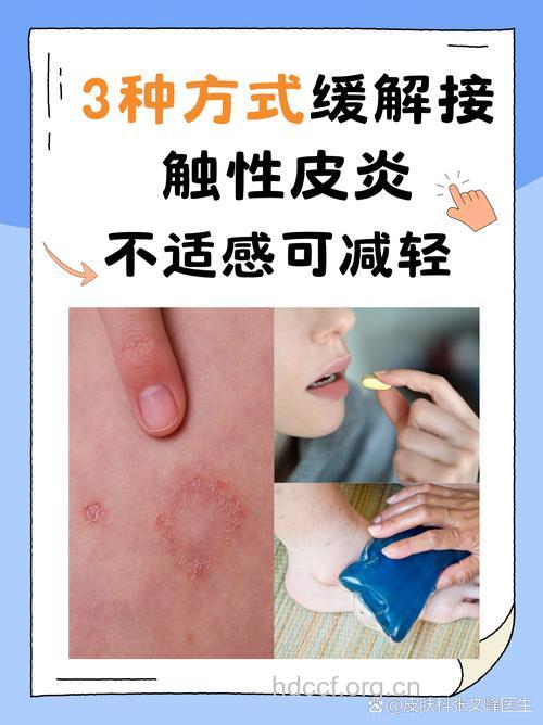 如何治疗和预防接触性皮炎