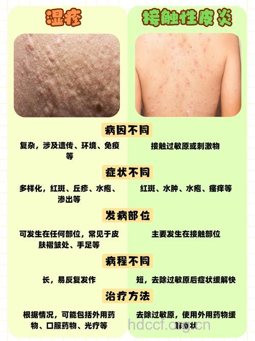 接触性皮炎和过敏性皮炎