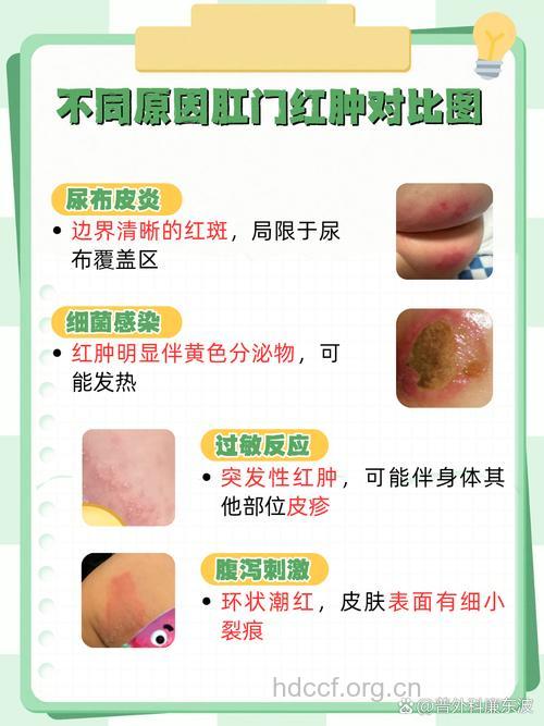 肛门接触性皮炎是什么原因