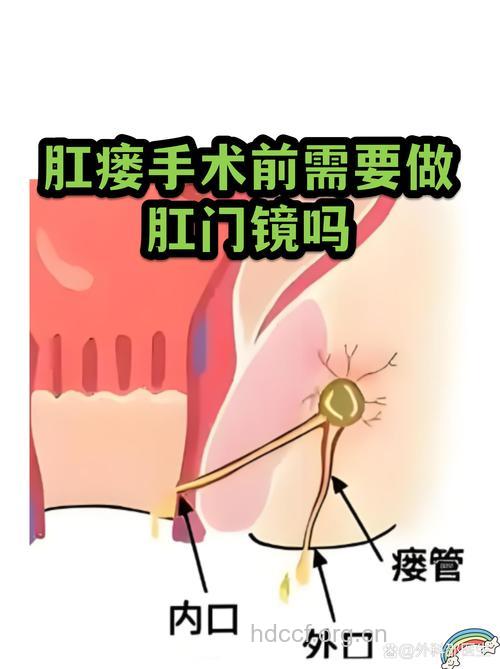 肛瘘内口的检查措施