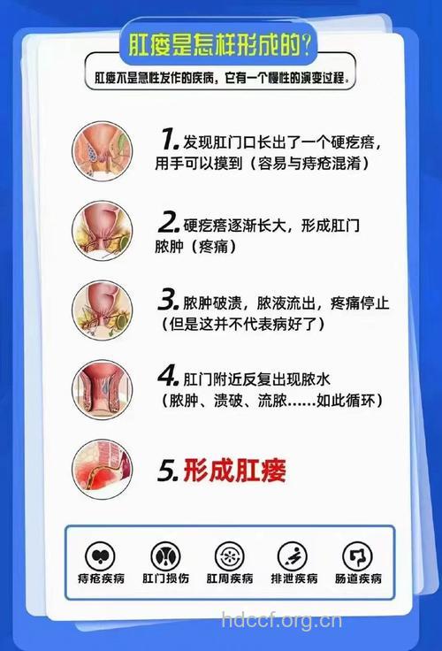 肛瘘是如何形成的呢