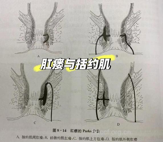 肛瘘按瘘管与括约肌的关系