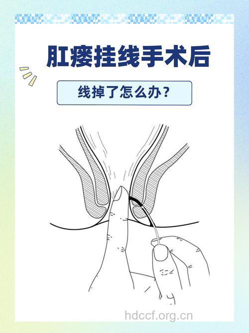 诊断肛瘘的方法