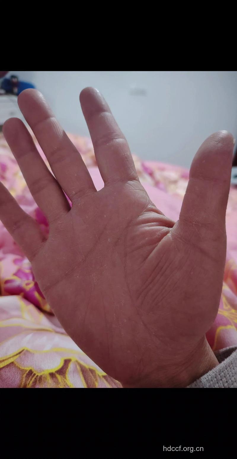 洗衣粉残留或致过敏性皮炎