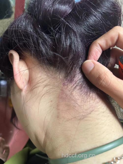 染发易得接触性皮炎