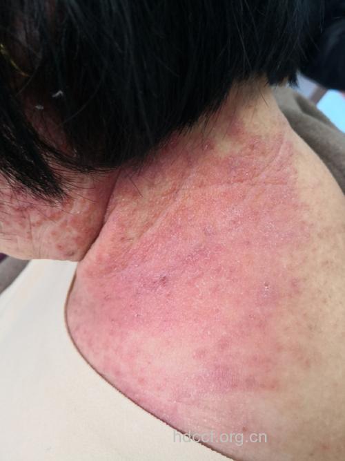 常染发引起接触性皮炎