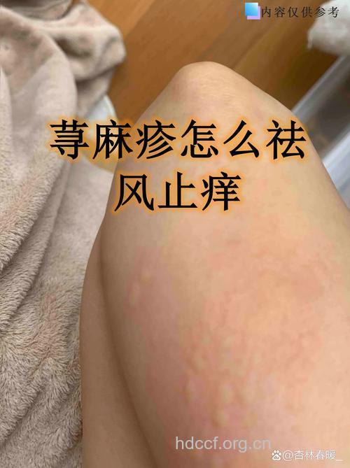 荨麻疹也有“心腹”之患