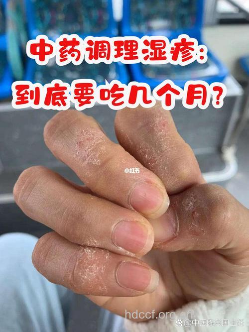 药膳治疗接触性皮炎