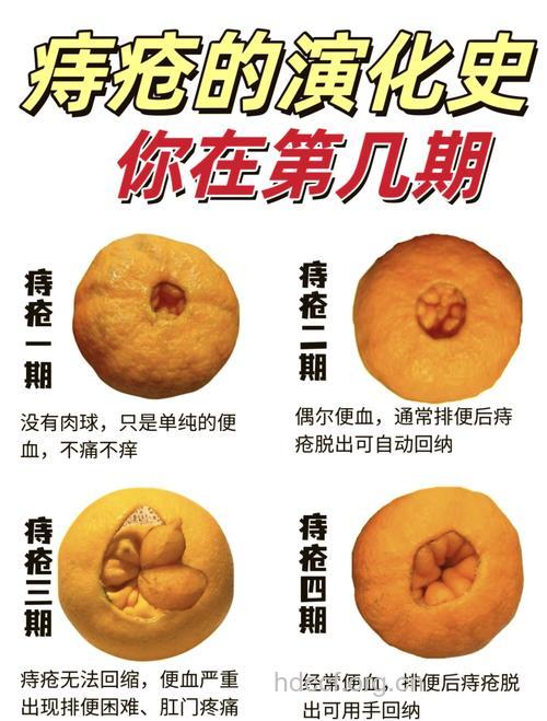 痔疮的各种早期症状