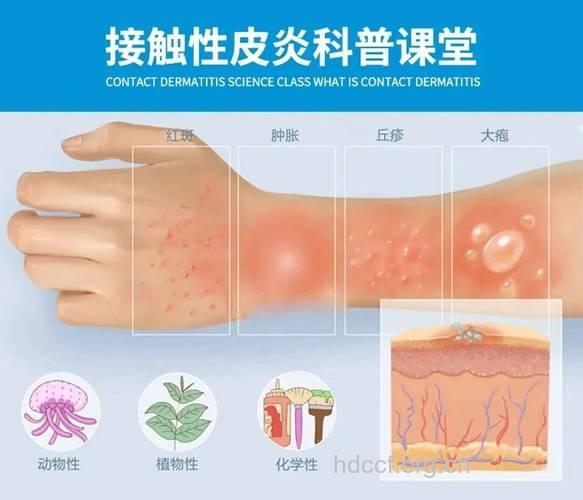 图解接触性皮炎