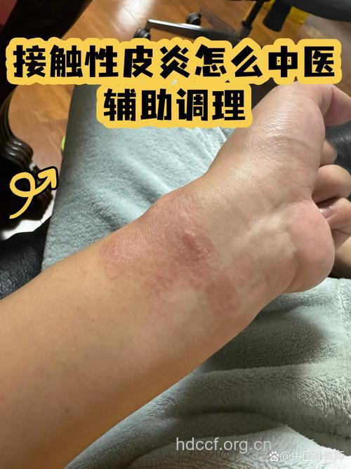 治疗接触性皮炎 中医显身手