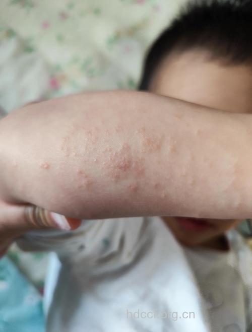 儿童玩沙也能诱发皮炎？