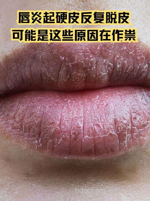劣质口红易引发唇炎